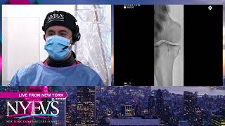 LIVE CASE PRESENTATION 5 ISR FEMOROPOPLITEAL DISEASE Broadcast From The Mount Sinai Hospital [upl. by Zealand]