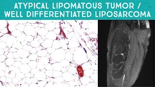 Well differentiated liposarcoma  quotAtypical lipomatous tumorquot mimicking lipoma Oregon Case 13 [upl. by Manouch]