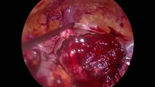 Myomectomy Laparoscopic SKAFF [upl. by Eerb]