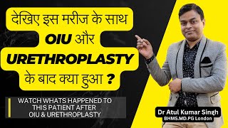 क्या OIU और URETHROPLASTY यूरेथ्रल स्ट्रिक्चर का परमानेंट इलाज है  मरीज की टेस्टिमोनी देखें [upl. by Huntingdon]