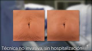 Radiofrecuencia Exilis Elite [upl. by Eahc129]