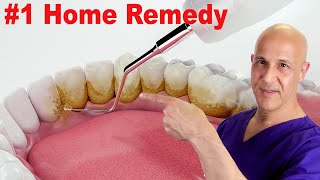 1 Home Remedy to Remove Dental Plaque amp Tarter to Prevent Cavities  Dr Mandell [upl. by Eloisa]