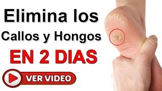 Elimina Callos Y Hongos De Los Pies En Solo 2 Días con este remedio casero de 2 ingredientes [upl. by Ibok360]