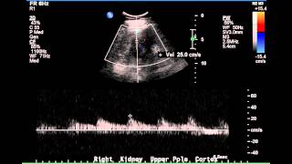 Duplex Demonstration of Normal Renal Arterial Blood Flow  Case Study [upl. by Nosredneh]