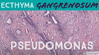 Ecthyma Gangrenosum Pseudomonas aeruginosa 5Minute Pathology Pearls Dermatology Dermatopathology [upl. by Mcnally]