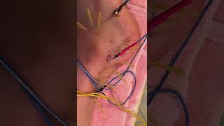 Ankle Pain Peroneus Tendon Dry Needling with Electrical Stimulation dryneedlingtherapy anklepain [upl. by Niledam]