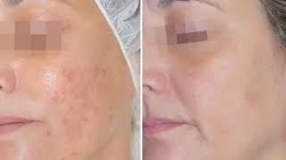 Acnelan treatment by Mesoestetic  before amp after [upl. by Alboran378]