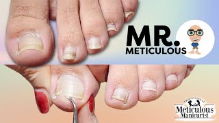 Impacted Toenail PEDICURE Cleaning on Mr Meticulous [upl. by Amikahs]