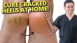 7 Cracked Heel Home Remedies That REALLY Work [upl. by Ahsemak]