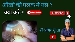 आँख की पलकों मे पस  Meibomitis eyecare Video258 [upl. by Roose]