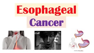 Esophageal Cancer  Risk Factors Pathogenesis Signs and Symptoms Diagnosis Treatment [upl. by Sesilu907]