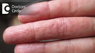 Difference between atopic dermatitis and eczema  Dr Rashmi Ravindra [upl. by Sidnala]