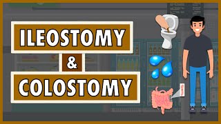 Ileostomy and Colostomy  Emphasis on DietNutrition [upl. by Enirod]