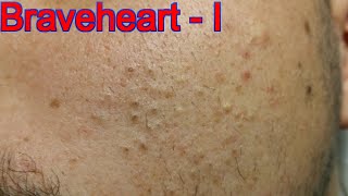 Extraction for Teenage Acne  Part 1 of 3 [upl. by Sheryl158]