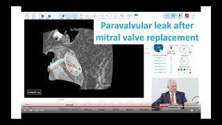 Mechanical Mitral Valve with paravalvular leak [upl. by Benzel]