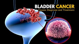 Bladder Cancer Causes Signs and Symptoms Diagnosis and Treatment [upl. by Amora985]