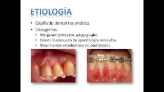 Clasificación de Recesiones Gingivales [upl. by Yesnnyl]