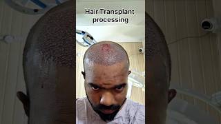 My hair Transplant Journey in One day 🤩 hairtransplant hairlinerestoration hairgrafting [upl. by Nefen778]