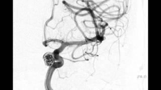 Neurointerventional Stroke Rounds  Aneurysm Coiling [upl. by Bowles]