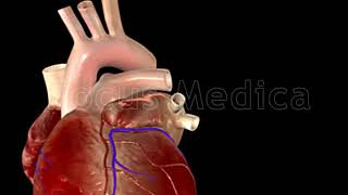 Atrial Fibrillation Triggers  Animated Atlas of Atrial Fibrillation [upl. by Vasos]