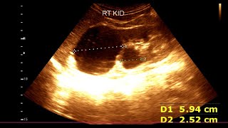 Cholelithiasis  Single  with normal wall thickening  Benign simple right renal cortical cyst [upl. by Eerehc]