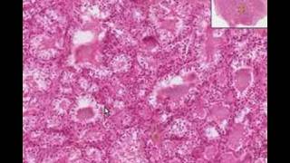 Histopathology ThyroidGraves Disease [upl. by Cleodel]