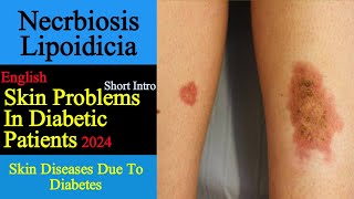 Nacrobiosis Lipoidica I Diabetes Necrobiosis Lipoidica I ADSi [upl. by Olleina]