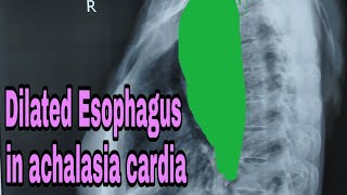 Achalasia cardia x ray finding [upl. by Nylazor]