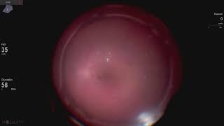 Retinal detachment repair Lukan Mishev live stream [upl. by Aiva]