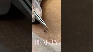 Long Ingrown Hair Removal [upl. by Ittak]