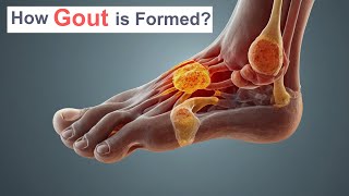 How Gout is Formed [upl. by Delilah690]