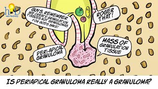 What is periapical granuloma [upl. by Bumgardner]