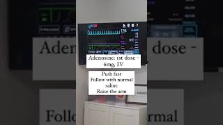 Heart rate 200 Cardioversion with Adenosine [upl. by Eugenia]