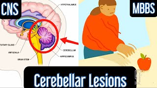 Signs of Cerebellar Lesions mbbs medicine next usmle [upl. by Negam]