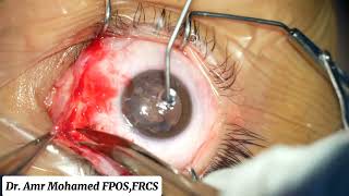 Consecutive Exotropia  Medial rectus advancement [upl. by Divine]