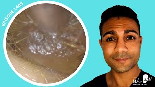 1489  Totally Blocked Ear Wax Removal from Both Ears [upl. by Thgiwd]