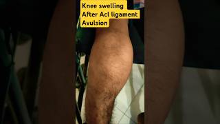 Knee Swelling after Acl ligament avulsion knee Effusionknee injuryACL completepartial tear [upl. by Sneed699]