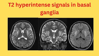 T2 hyperintense signals in basal ganglia [upl. by Ardnuasac677]