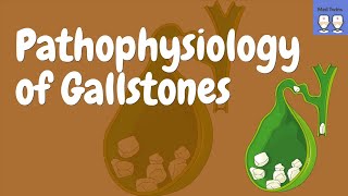 Gallstones Pathophysiology Cholecystitis Choledocholithiasis Diagnosis ComplicationsTreatment [upl. by Akeylah]