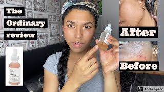 The Ordinary Lactic acid 10  HA 2 HONEST reviewopinion with before amp after [upl. by Tatianna]