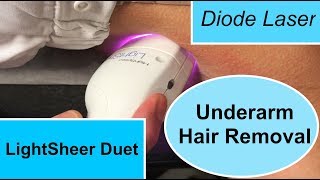 The LightSheer Duet Diode Laser for Underarm Hair Removal [upl. by Alihs]