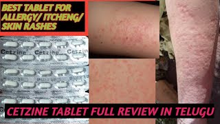 BEST TABLET FOR ALLERGY AND SKIN RASHES AND ITCHINGCETZINE TABLET USES DOSE FULL REVIEW IN TELUGU [upl. by Nezah]