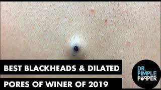 Best Of Blackheads and Dilated Pores of Winer for 2019 [upl. by Areema337]