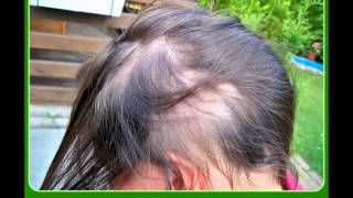 Antiscal  Alopecia Areata [upl. by Rodi774]