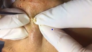 How To Remove Blackheads And Whiteheads On Face Easy 12 ✦ Dr Laelia ✦ [upl. by Ayamahs]