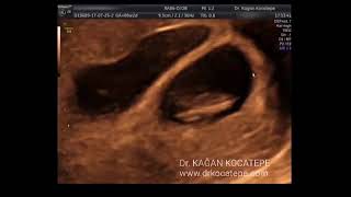 How is an 8 weeks dichorionic diamniotic twin pregnancy seen on ultrasound Possible lambda sign [upl. by Heimer83]