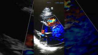 Estenosis Valvular Aòrtica po Ecocardiografia Doppler color Plano Para sete al [upl. by Namilus]