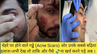 Acne Scars Types And Treatments । चेहरे के गड्ढो के प्रकार ओर उनके इलाज । HEALTHWITHBEAUTY [upl. by Dragone]