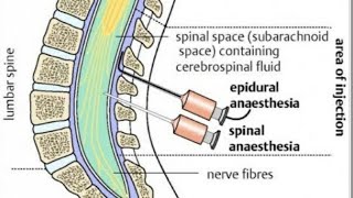 Spinal anaesthesia in hindi spinal anaesthesia lecture  spinal anatomy  procedure [upl. by Drallim]