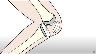 Knee Replacement vs Regenexx Orthopedic Regenerative Treatment [upl. by Llednew9]